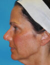 Neck Lift case #6923