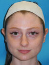 Otoplasty case #7024