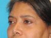 Blepharoplasty case #6940