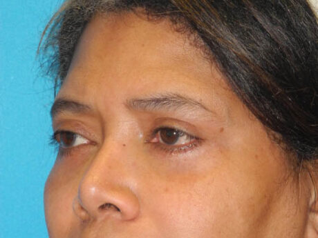 Blepharoplasty case #6940