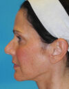 Neck Lift case #6923