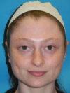 Otoplasty case #7024