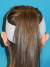 Otoplasty case #7024