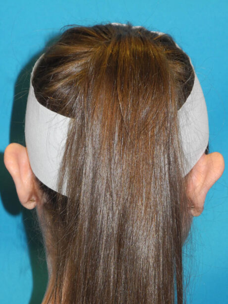 Otoplasty case #7024