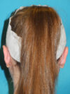 Otoplasty case #7024