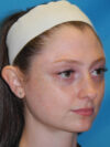 Otoplasty case #7024
