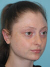 Otoplasty case #7024
