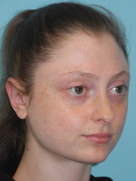 Otoplasty case #7024