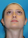 Otoplasty case #7024