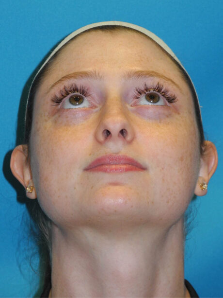 Otoplasty case #7024