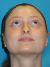 Otoplasty case #7024