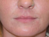Lip Filler case #6932