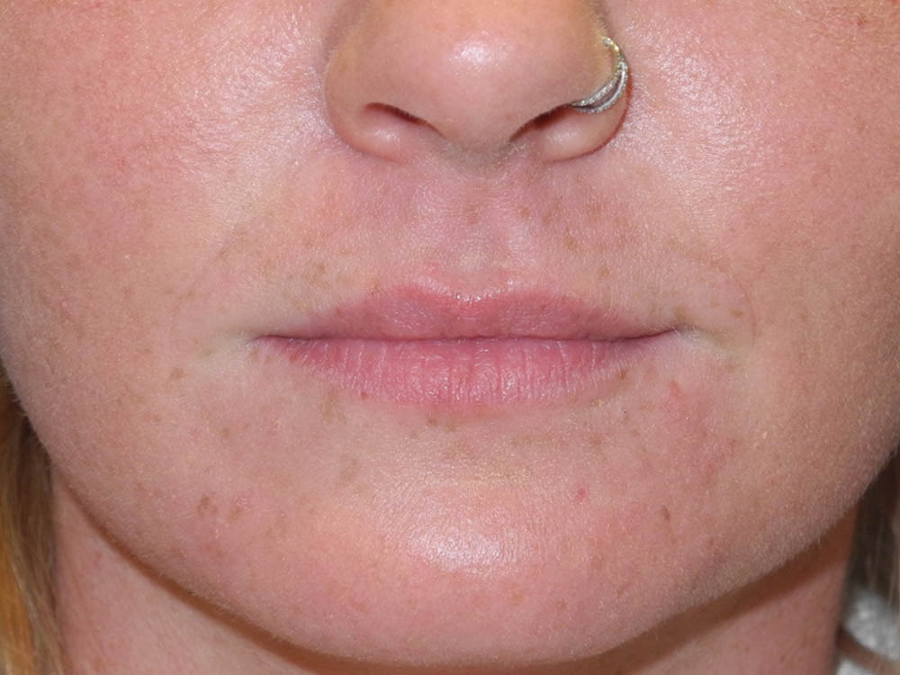 Lip Filler case #6932