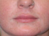 Lip Filler case #6932