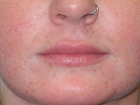 Lip Filler case #6932