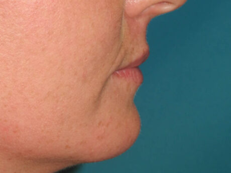 Lip Filler case #6932
