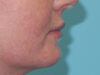 Lip Filler case #6932