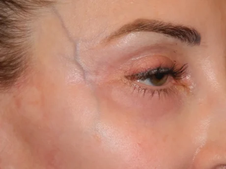 Excision of Ophthalmic Varicosity case #7398