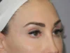 Excision of Ophthalmic Varicosity case #7398